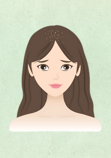 Dandruff